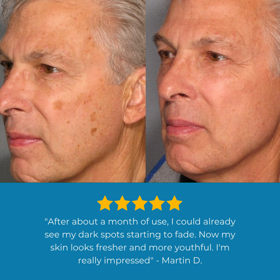 Nuriden™ Age Spot Cream